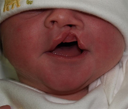 cleft-lip1 Janelle Aby, MD Stanford.jpg